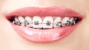 What do braces feel like?