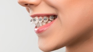 Moderate Overbite