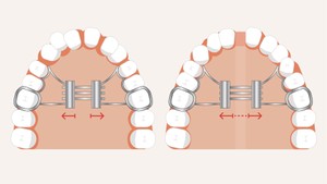 Why Some Patients Need a Palatal Expander