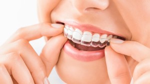 Invisalign and Dental Implants