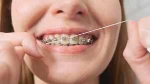 How to Take Care of Braces