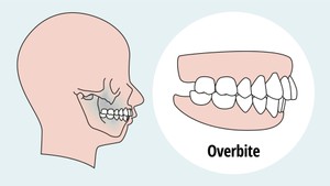 Overbite correction, moderate overbite and minor overbite