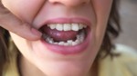 types of orthodontic crowding