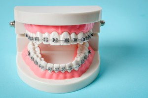 how long does it take to get used to braces