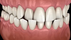 What is a crossbite and what causes a crossbite?