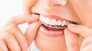 invisalign before &amp; after treatment